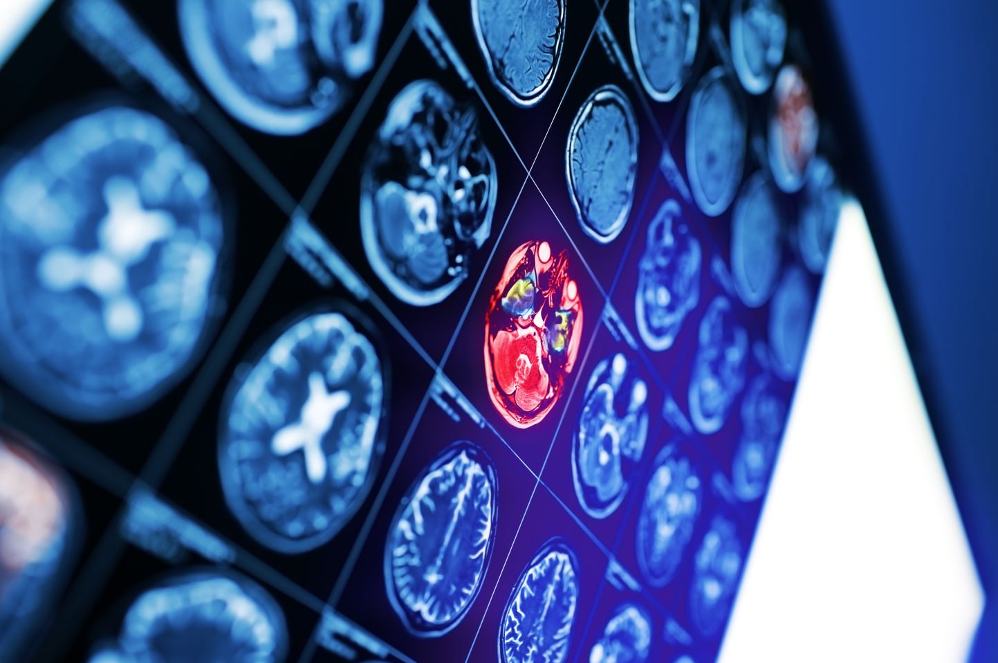 Brain injuries can be catastrophic, causing immediate cognitive disabilities. In other situations, the repercussions of brain trauma may not appear immediately in the victim.